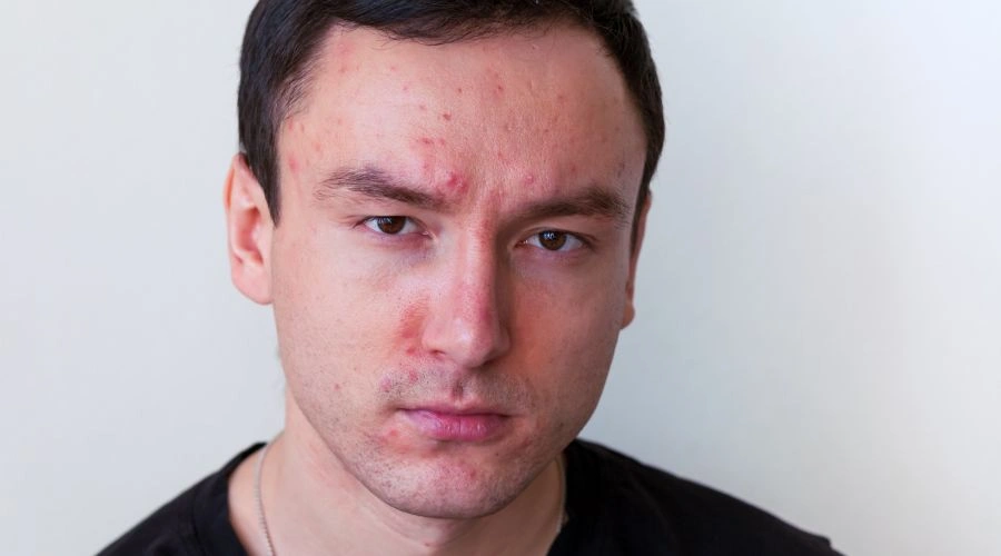 Does Alcohol Cause Acne?